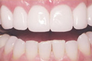 bleeding gums - Dentist West Covina