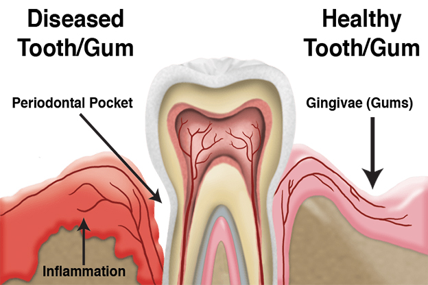 What is the difference between Gingivitis, Receding Gums and Gum Disease?